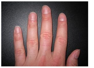 IMATE LI OVAKVE IZBOČINE NA NOKTIMA – evo šta one znače: Doktorica otkrila i možda ćete se iznenaditi