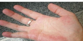 Ako ste primijetili ovaj simptom na svojim rukama, VJEROVATNO JE DA NEKI VAŽAN ORGAN NE RADI