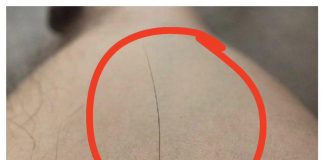 Imate li mladež iz kojeg raste dlaka? Evo šta to znači