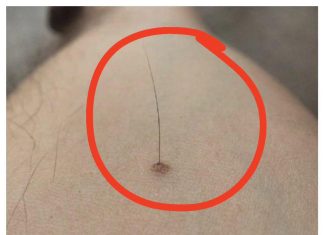 Imate li mladež iz kojeg raste dlaka? Evo šta to znači