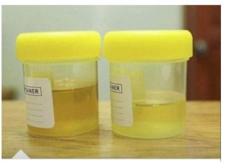 Osjetite li jak miris urina kada ustanete sa sjedišta? To nije infekcija urinarnog trakta, već mnogo opasnije stanje koje vas muči!