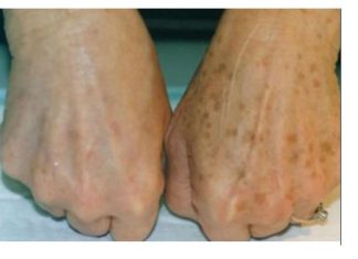 PRIMJETILI STE DA VAM SE POJAVLJUJU STARAČKE PJEGE : To je znak da imate ozbiljan problem sa jednim organom!