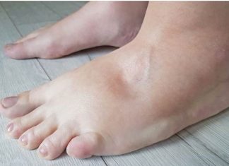 EVO KAKO DA IZBACITE VIŠAK VODE IZ TIJELA: Noge vam više neće biti natečene, evo šta trebate uraditi