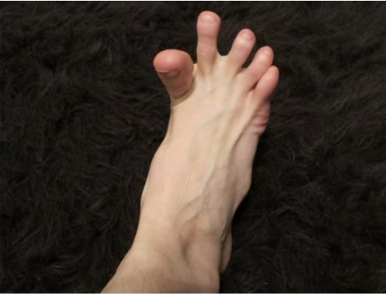 DA LI VAM SE GRČE PRSTI NA STOPALIMA? Evo Na Šta Vas To Upozorava, Može Biti Znak Većih Problema