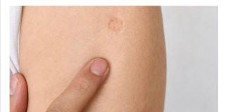 Svi rođeni u Jugoslaviji imaju ovaj ožiljak na ruci: Znate li kako je nastao i zbog čega? Svi su iznenađeni