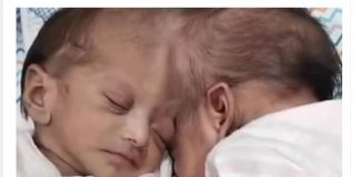 Kako žive Mina i Mirka, sijamske bliznakinje koje su turski doktori razdvojili: Prvih dana nisu mogle jedna bez druge