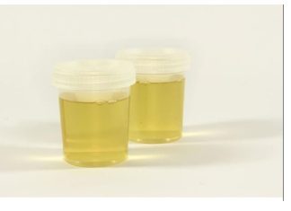 Vidite li mjehuriće u urinu? To može ukazivati na ozbiljnije zdravstveno stanje!