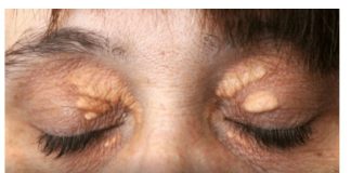 Ako vam se u blizini očiju pojavilo masno tkivo: Nipošto nemojte ga stiskati, morate učiniti sledeće da nestane! (Foto)