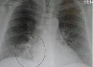 OVA SMJESA JAČA IMUNITET, LIJEČI PLUĆA, DJELUJE PROTIVUPALNO: Trebaju Vam SAMO 3 SASTOJKA