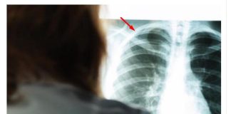 Karleuša imala infarkt pluća! Pjevačica prikovana za krevet: “Dva tromba su se otkačila i otišla gdje ne treba”