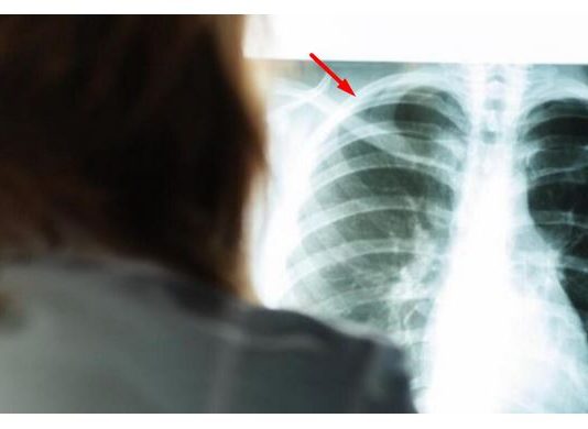 Karleuša imala infarkt pluća! Pjevačica prikovana za krevet: “Dva tromba su se otkačila i otišla gdje ne treba”