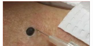 Žena je OVO gajila 10 godina na leđima misleći da je bezazleno..posjet doktoru je sve ostavio bez teksta.Jedva izvukla živu glavu!!!