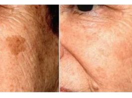 POZNATI DERMATOLOG OTKRIO: Ovo je uloga sode bikarbone u liječenju mrlja na licu!