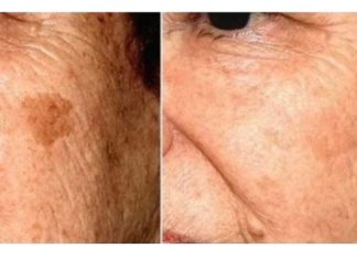 POZNATI DERMATOLOG OTKRIO: Ovo je uloga sode bikarbone u liječenju mrlja na licu!