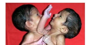 Maja je rodila ćerke spojene srcem i ostavila ih u bolnici: Sudbina sijamskih bliznakinja podigla celu naciju na noge, a kad su ih razdvojili usledio pakao