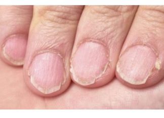 MUČE VAS UMOR, TANKA KOSA I LOMLJIVI NOKTI, EVO ŠTA VAM NEDOSTAJE U ISHRANI