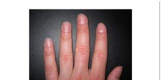 IMATE LI OVAKVE IZBOČINE NA NOKTIMA – evo šta one znače: Doktorica otkrila i možda ćete se iznenaditi