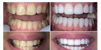 Pomešajte ova dva sastojka i imate prirodnu pastu za izbeljivanje zuba: Blistav osmeh u trenu, a ne košta ništa