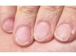 MUČE VAS UMOR, TANKA KOSA I LOMLJIVI NOKTI, EVO ŠTA VAM NEDOSTAJE U ISHRANI