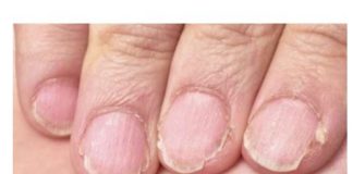 MUČE VAS UMOR, TANKA KOSA I LOMLJIVI NOKTI, EVO ŠTA VAM NEDOSTAJE U ISHRANI