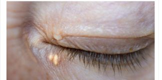 STAVILA SAM OVU NAMIRNICU NA MASNO TKIVO KOD OKA, ono je preko noći nestalo: EVO ŠTA ME SPASILO, SVI GA IMATE U KUĆI