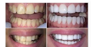 Pomešajte ova dva sastojka i imate prirodnu pastu za izbeljivanje zuba: Blistav osmeh u trenu, a ne košta ništa