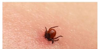 Bezbolno je i nema čupanja: Doktorka otkrila trik kako da se krpelj sam otkači sa kože (video)