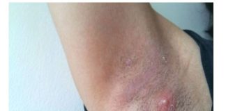 LJUDI SE NE PERU ISPOD PAZUHA KAKO TREBA: Stručnjak za higijenu savetuje čime da izlečite bubuljice i uklonite znoj