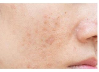 Evo kako da sa ovim jednostavnim trikom od 2 sastojka izbrišete mrlje s kože!