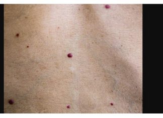 IMATE LI OVE CRVENE TAČKICE NA TIJELU? To nisu popucali kapilari, EVO O ČEMU SE ZAISTA RADI