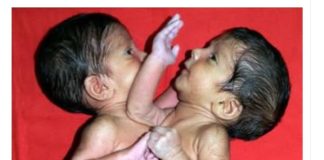 Maja je rodila ćerke spojene srcem i ostavila ih u bolnici: Sudbina sijamskih bliznakinja podigla celu naciju na noge, a kad su ih razdvojili usledio pakao