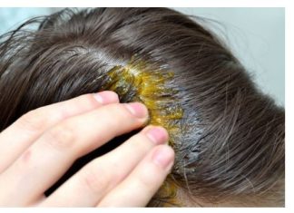 BUBULJICE NA GLAVI SU SVE ČEŠĆI PROBLEM: Ni slučajno ih ne istiskujte, evo zašto se javljaju I ŠTA TREBATE URADITI DA NESTANU