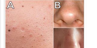 MITISERI SAMI ISPADAJU IZ PORA, ŽENA POKAZALA GENIJALAN TRIK: Uradite ove 3 stvari i oduševit ćete se licem (FOTO)