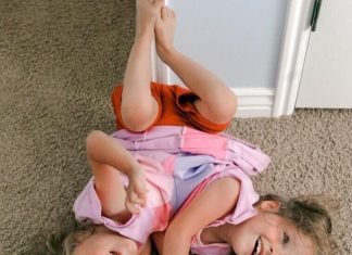 Sijamske bliznakinje rođene sa spojenom karlicom, imale su samo dve noge i predviđali su im 24 sata života: A ono što danas rade i kako izgledaju je neverovatno