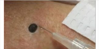 ŽENA JE GAJILA OVO NA LEĐIMA: Kada je doktorka uzela špric i bocnula, shvatit ćete zašto je SNIMAK pregledalo 33 miliona ljudi!