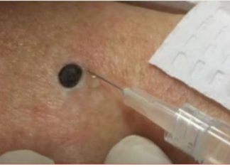 ŽENA JE GAJILA OVO NA LEĐIMA: Kada je doktorka uzela špric i bocnula, shvatit ćete zašto je SNIMAK pregledalo 33 miliona ljudi!