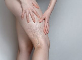 Svatko kod kuće ima lijek za popucale kapilare, ali mnogi ljudi to ne znaju!