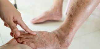 7 znakova da se tijelo već duže vrijeme bori s VISOKIM ŠEĆEROM UKRVI: Prvo ćete to primijetiti na očima i nogama! (FOTO)