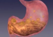 BOLJI LIJEK ZA GASTRITIS OD OVOG NE POSTOJI: Bolovi u želucu će nestati već nakon prve čaše! (ZAPIŠITE RECEPT)