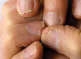 MUČE VAS UMOR, TANKA KOSA I LOMLJIVI NOKTI, EVO ŠTAVAM NEDOSTAJE U ISHRANI