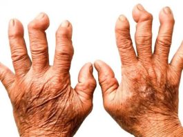 VAŠE KOSTI NE VOLE OVU HRANU: Ako Ovo Jedete, Bol Je Jači, Artritis Napreduje, Zglobovi Se Troše…