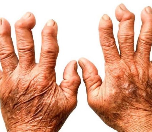 VAŠE KOSTI NE VOLE OVU HRANU: Ako Ovo Jedete, Bol Je Jači, Artritis Napreduje, Zglobovi Se Troše…