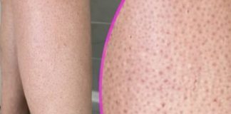 OVE TAČKICE NA NOGAMA VAM KVARE LJETO? Evo kako da ih se riješite, koža će vam biti glatka