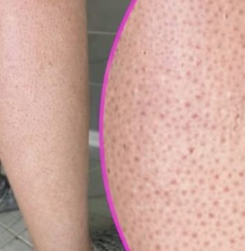 OVE TAČKICE NA NOGAMA VAM KVARE LJETO? Evo kako da ih se riješite, koža će vam biti glatka