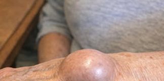 Doktori otkrivaju da ako vam se preko noći razvije ova čudna kvržica na zglobu, to znači da imate … Doktori otkrivaju da ako vam se preko noći razvije ova čudna kvržica na zglobu, to znači da imate … - featured image