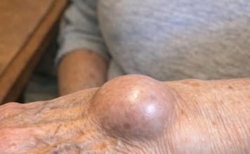 Doktori otkrivaju da ako vam se preko noći razvije ova čudna kvržica na zglobu, to znači da imate … Doktori otkrivaju da ako vam se preko noći razvije ova čudna kvržica na zglobu, to znači da imate … - featured image