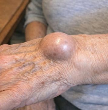 Doktori otkrivaju da ako vam se preko noći razvije ova čudna kvržica na zglobu, to znači da imate … Doktori otkrivaju da ako vam se preko noći razvije ova čudna kvržica na zglobu, to znači da imate … - featured image