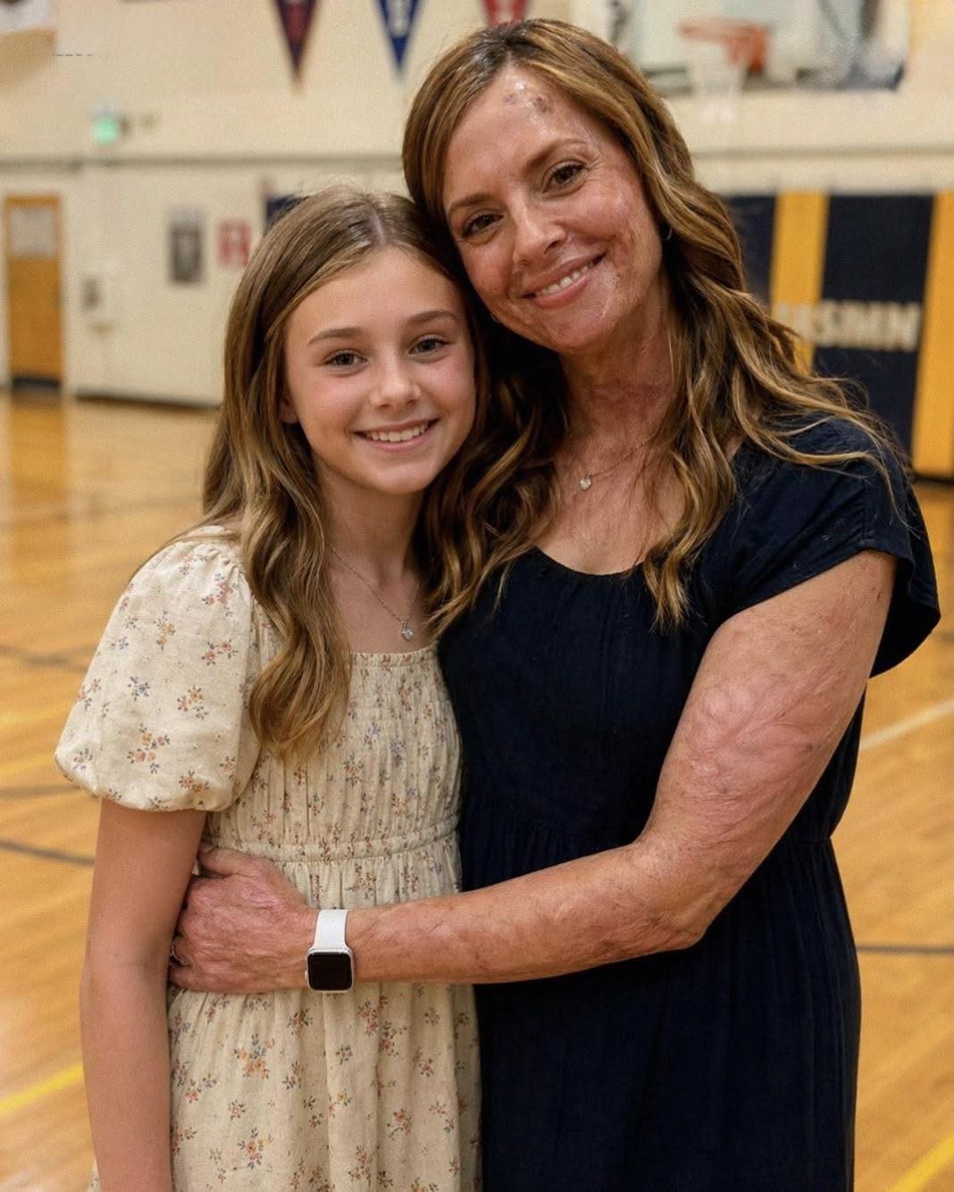 MOJU KĆERKU SU ISMIJAVALI ZBOG MOG OŽILJKA — a onda je stranac ušao u školu i izgovorio rečenicu zbog koje je cijela sala zanijemila - featured image