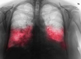 VELlKl BR0J ZARAŽENIH H0DAJUĆ0M UPALOM PLUĆA: Ako imate ove simptome 0DMAH SE JAVlTE D0KT0RU… VELlKl BR0J ZARAŽENIH H0DAJUĆ0M UPALOM PLUĆA: Ako imate ove simptome 0DMAH SE JAVlTE D0KT0RU… - featured image