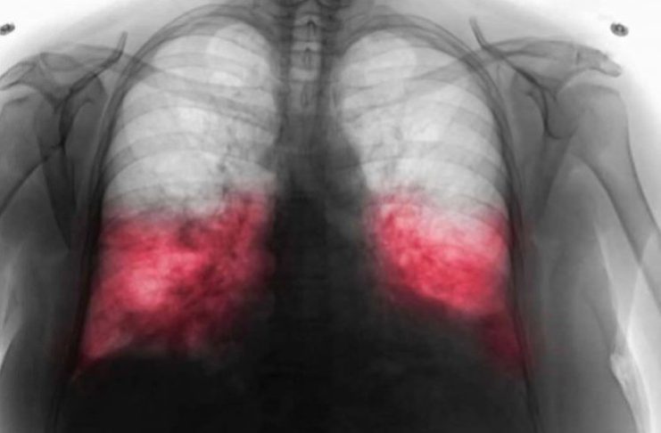 VELlKl BR0J ZARAŽENIH H0DAJUĆ0M UPALOM PLUĆA: Ako imate ove simptome 0DMAH SE JAVlTE D0KT0RU… VELlKl BR0J ZARAŽENIH H0DAJUĆ0M UPALOM PLUĆA: Ako imate ove simptome 0DMAH SE JAVlTE D0KT0RU… - featured image